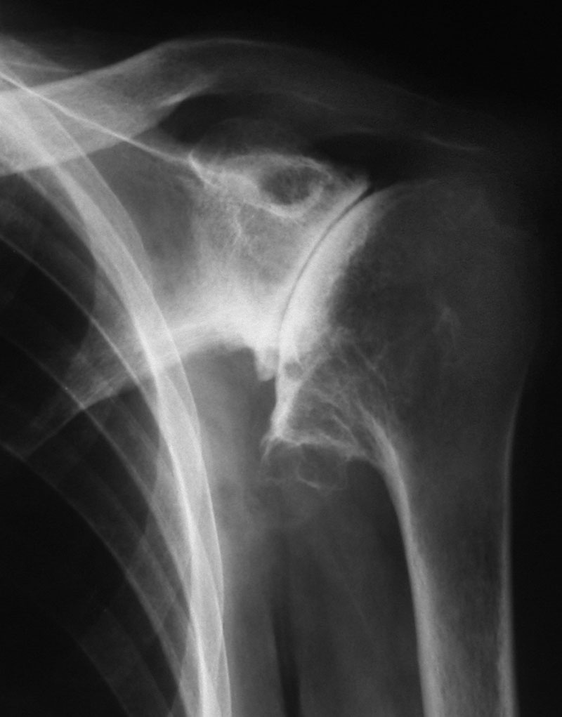 vállízületi arthrosis nyaki gerinc osteochondrosisa 1 fok