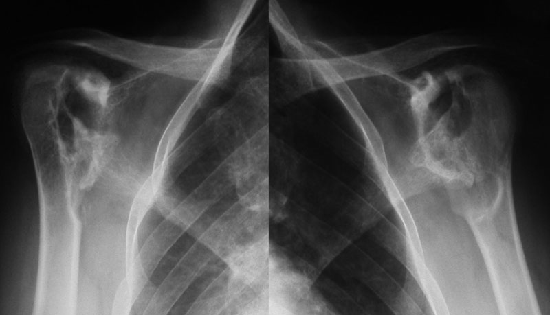 arthrosis osteoporosis a vállízület hogyan kezeljük az 1 fokú lábízületet