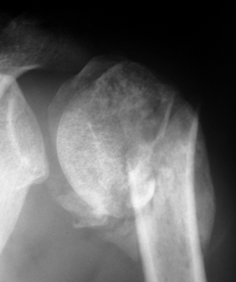 arthrosis osteoporosis a vállízület kenőcs kenőcs ízületekre ár