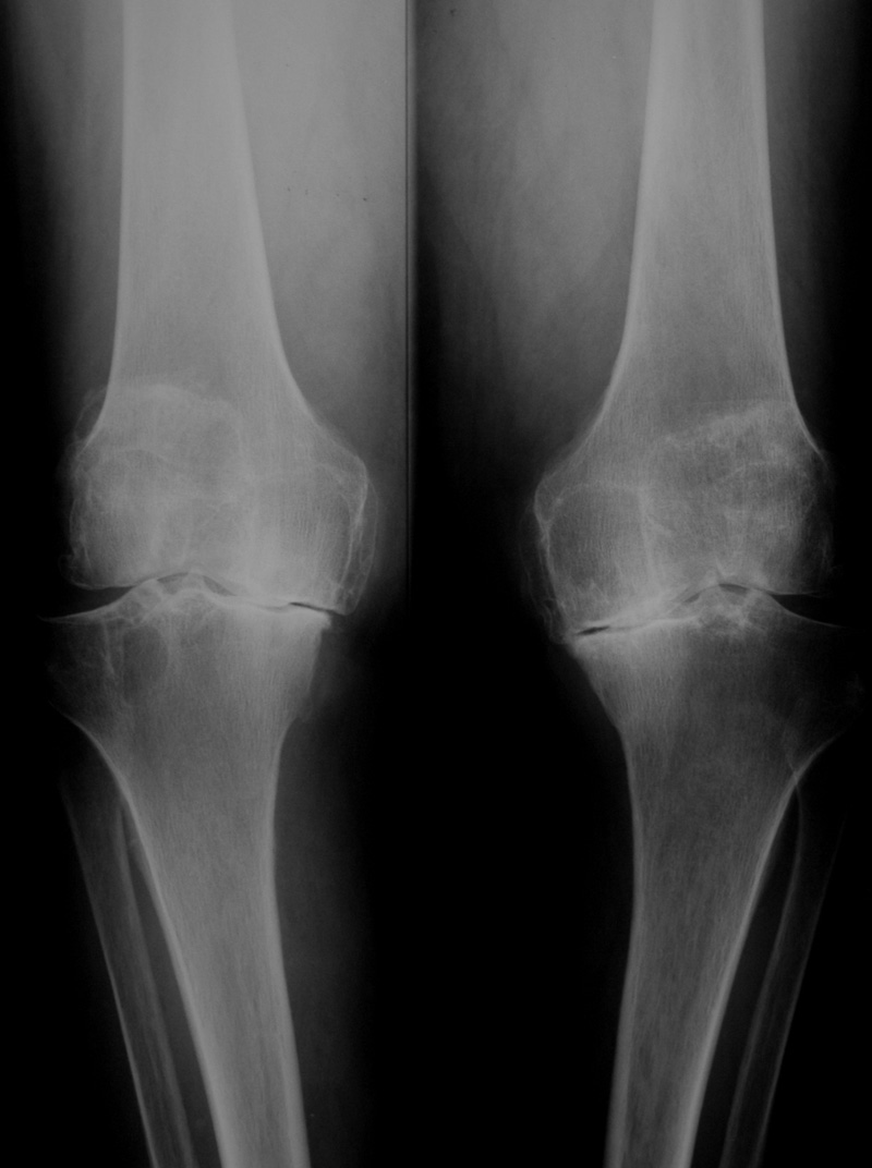 deformáló osteoarthritis az ízületek 1. fokú csípőízületi fájdalom osteoarthritis
