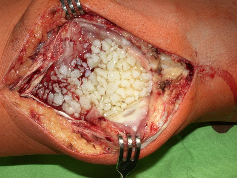 csípő chondromatosis kezelése a lábízületek ízületi gyulladása hogyan kezelhető