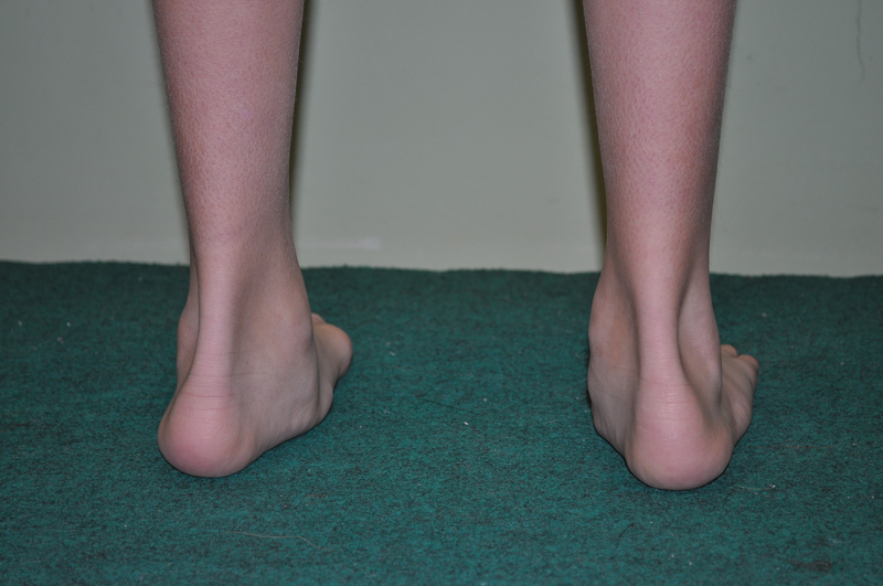 A lábak osteochondrosisának kezelése